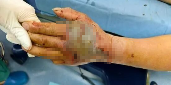 大爷杀死剧毒眼镜蛇，5分钟后离断蛇头突然&ldquo;复仇&rdquo;&hellip;&hellip;医生提醒