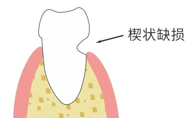 睡前，别忘了刷牙！（附4点科学护牙妙招）