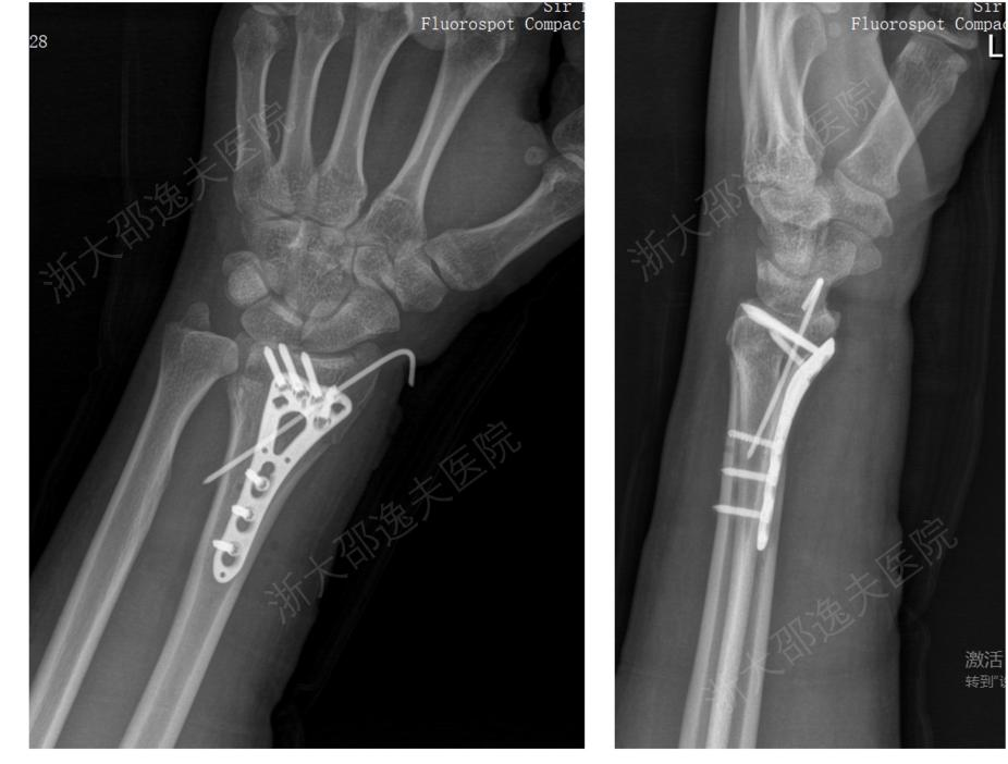 &ldquo;骨胶水&rdquo;来了，断骨黏合只需3分钟！