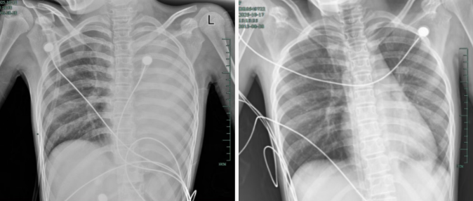 发热仅1天，肺全白了！这种病极度危险，千万别当普通感冒